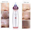 Blackhead Remover Pore Vacuum Cleaner - Armageddon Sports